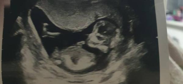 Bild zu Baby Geschlecht - Schwanger - wer noch? Rund um die Schwangerschaft
