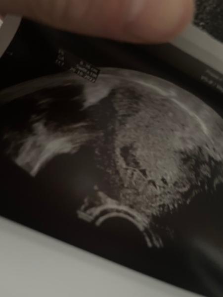 Bild zu Ssw 6 Fehlgeburt? - Schwanger - wer noch? Rund um die Schwangerschaft