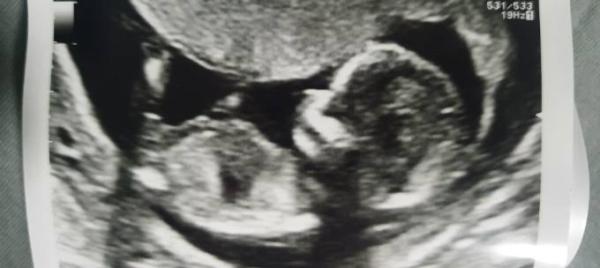 Bild zu Baby Geschlecht 🥲 - Schwanger - wer noch? Rund um die Schwangerschaft