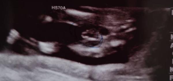 Bild zu 15ssw geschlecht ? - Schwanger - wer noch? Rund um die Schwangerschaft