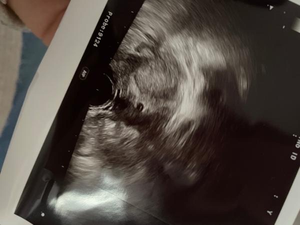 Bild zu Schwanger 6ssw - Schwanger - wer noch? Rund um die Schwangerschaft