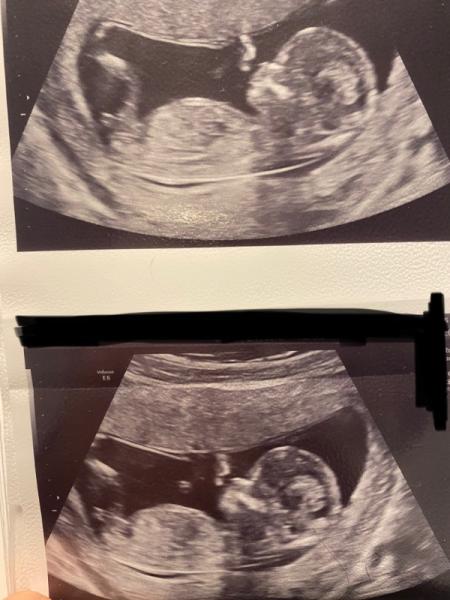 Bild zu Mädchen oder Junge 💙💖😇 - Schwanger - wer noch? Rund um die Schwangerschaft