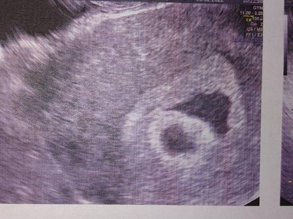 Bild zu 2 Fruchthöhlen?! Eine evtl leer - Schwanger - wer noch? Rund um die Schwangerschaft