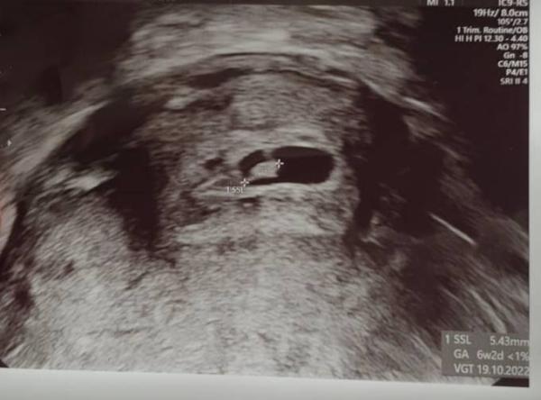 Bild zu Baby zu klein - Schwanger - wer noch? Rund um die Schwangerschaft