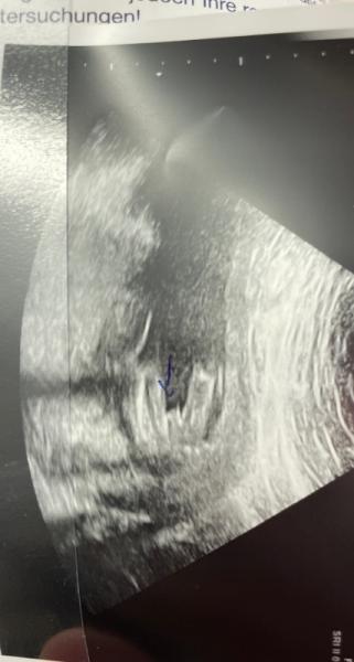 Bild zu Junge….17 ssw Oder doch Mädchen - Schwanger - wer noch? Rund um die Schwangerschaft