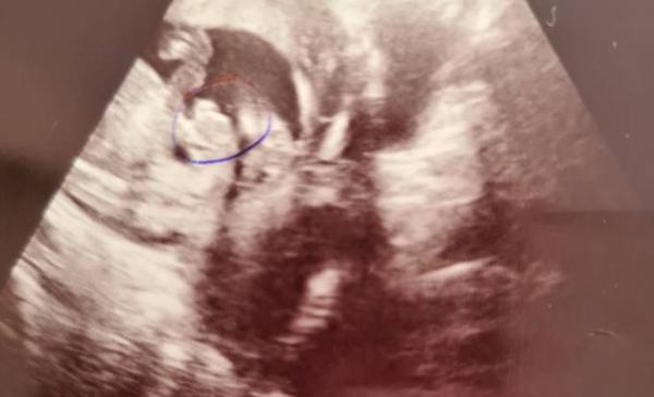 Bild zu 17ssw geschlecht? - Schwanger - wer noch? Rund um die Schwangerschaft