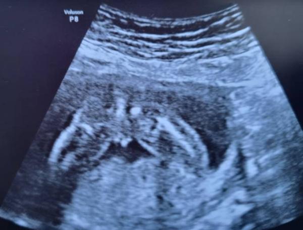 Bild zu Geschlecht junge oder mädchen - Schwanger - wer noch? Rund um die Schwangerschaft