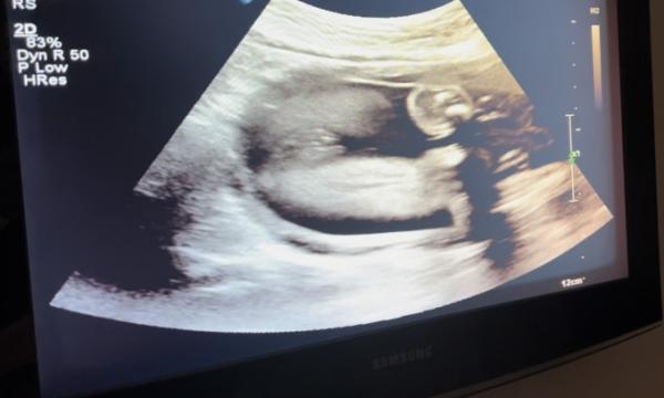 Bild zu Mädchen oder junge - Schwanger - wer noch? Rund um die Schwangerschaft