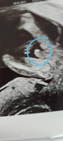 Bild zu Mädchen oder Junge? :) - Schwanger - wer noch? Rund um die Schwangerschaft