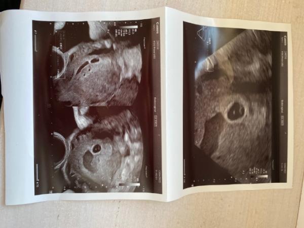 Bild zu Ultraschall 6+2 - Schwanger - wer noch? Rund um die Schwangerschaft