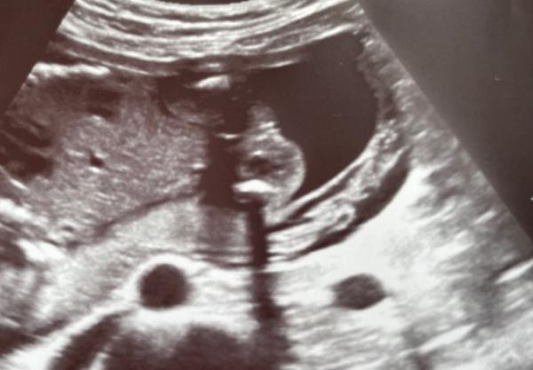 Bild zu Mädchen oder Junge? - Schwanger - wer noch? Rund um die Schwangerschaft
