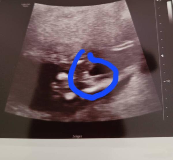 Bild zu Mädchen oder Junge ??????????? - Schwanger - wer noch? Rund um die Schwangerschaft