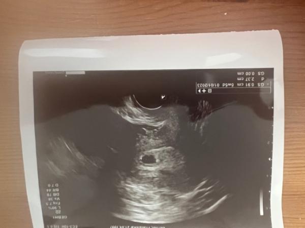 Bild zu Ist da wohl ein Embryo zu sehen?? - Schwanger - wer noch? Rund um die Schwangerschaft