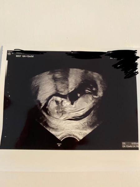 Bild zu Nub Methode Junge oder Mädchen - Schwanger - wer noch? Rund um die Schwangerschaft