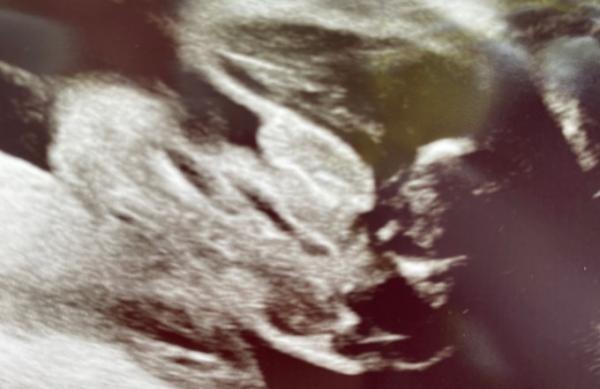 Bild zu Junge oder Mädchen - erstes kind - Schwanger - wer noch? Rund um die Schwangerschaft