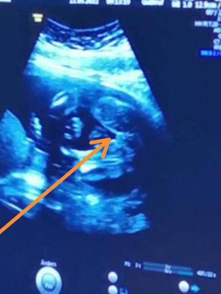 Bild zu Ich brauch mal eure adleraugen - Schwanger - wer noch? Rund um die Schwangerschaft
