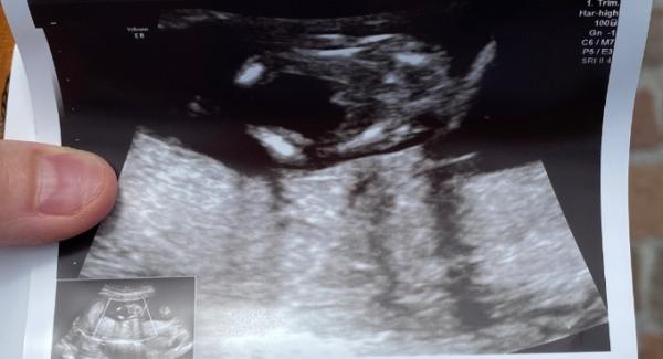 Bild zu Boy or Girl - Schwanger - wer noch? Rund um die Schwangerschaft