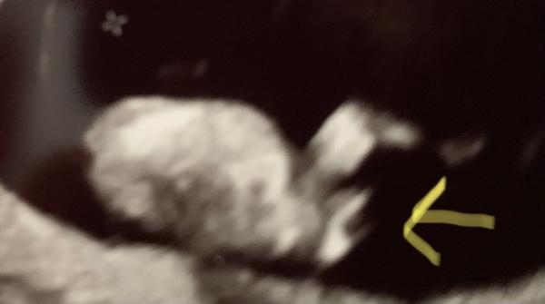 Bild zu Ist das der Nub? Danke :-) - Schwanger - wer noch? Rund um die Schwangerschaft