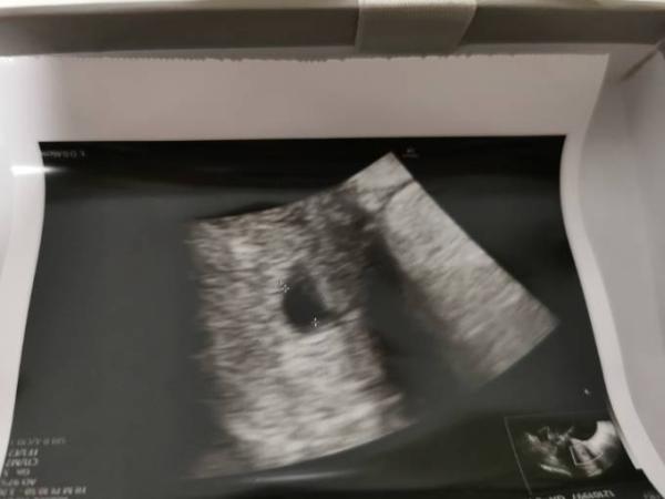 Bild zu Ultraschall Bild frage - Schwanger - wer noch? Rund um die Schwangerschaft