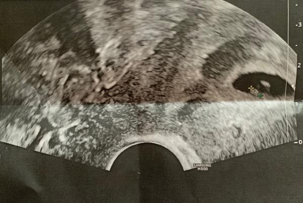 Bild zu RAMZI-Methode Mädchen oder Junge ???💖💙 - Schwanger - wer noch? Rund um die Schwangerschaft