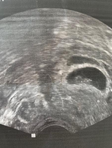 Bild zu 6+1 plötzlich Zweite Fruchthöhle 😳😳Eure Meinung bitteee??? - Schwanger - wer noch? Rund um die Schwangerschaft