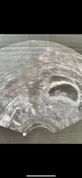 Bild zu 2-te Fruchthöhle oder doch Hämatom? 😢😢 - Schwanger - wer noch? Rund um die Schwangerschaft