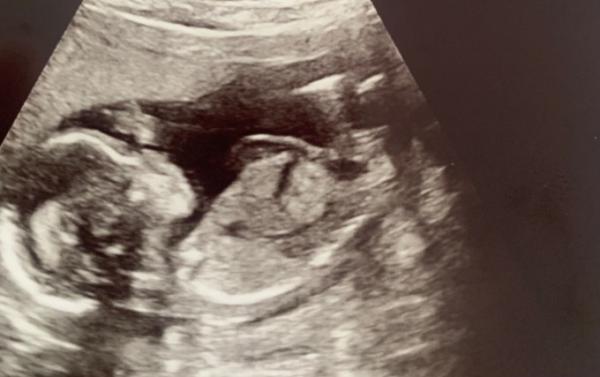Bild zu Junge oder Mädchen? - Schwanger - wer noch? Rund um die Schwangerschaft