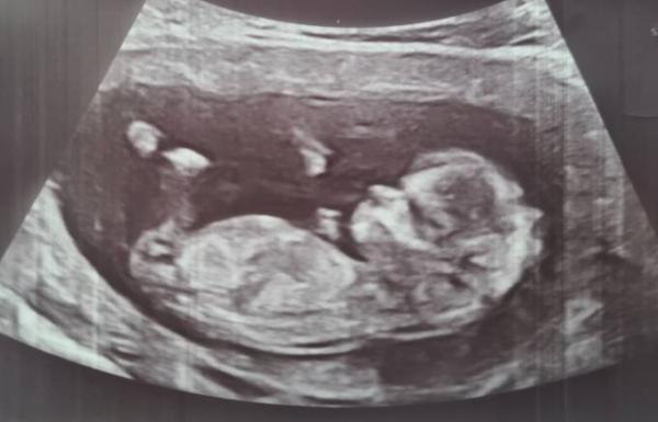 Bild zu Skull Theorie - jemand eine Idee? - Schwanger - wer noch? Rund um die Schwangerschaft