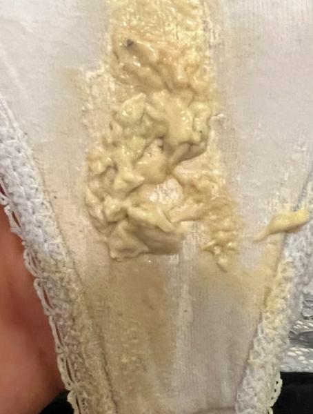 Bild zu starker Ausfluss/ 6. SSW/ VORSICHT FOTO! - Schwanger - wer noch? Rund um die Schwangerschaft
