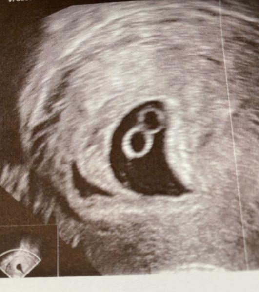 Bild zu Erst 1 Dottersack mit Embryo verhaltener Abord eine Woche später 2 Dottersäcke? - Schwanger - wer noch? Rund um die Schwangerschaft