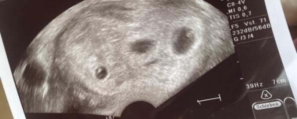 Bild zu Drillinge habe angst - Schwanger - wer noch? Rund um die Schwangerschaft