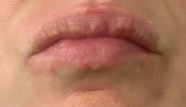 Bild zu Ist das Herpes? - Schwanger - wer noch? Rund um die Schwangerschaft