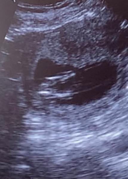 Bild zu Mädchen oder Junge ? 💗💙Was denk Ihr? 👶🏼 - Schwanger - wer noch? Rund um die Schwangerschaft