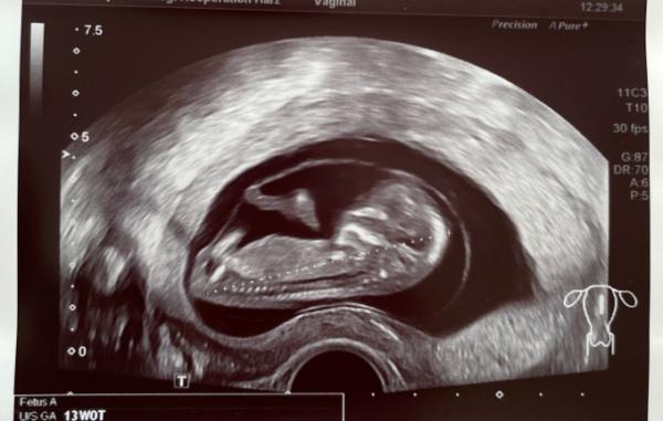 Bild zu Ultraschall Bild 12+1 Schwangerschaftswoche - Schwanger - wer noch? Rund um die Schwangerschaft