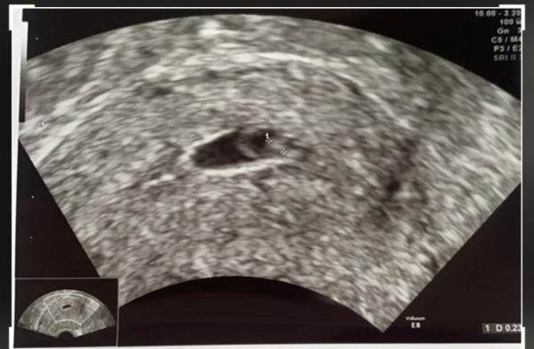 Bild zu Ist mein Embryo zu klein? Ärztin vermessen? - Schwanger - wer noch? Rund um die Schwangerschaft