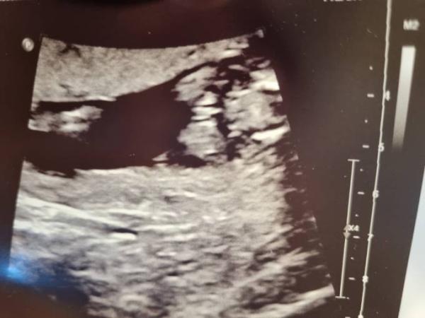 Bild zu Geschlecht 15+4 ssw - Schwanger - wer noch? Rund um die Schwangerschaft