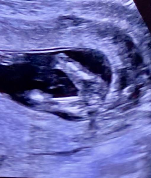 Bild zu Mamis Was wĂŒrdet ihr sagen? FA nicht sicherđđ - Schwanger - wer noch? Rund um die Schwangerschaft