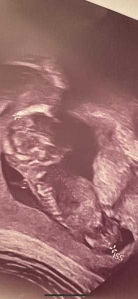 Bild zu Mädchen oder Junge ? Was meint ihr :) - Schwanger - wer noch? Rund um die Schwangerschaft