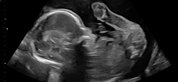 Bild zu SSW 22 - Bub oder Mädchen? - Schwanger - wer noch? Rund um die Schwangerschaft