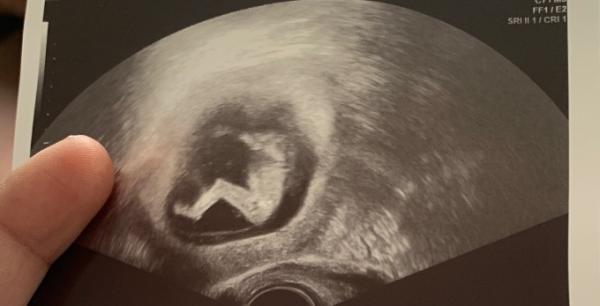 Bild zu Mädchen oder junge? - Schwanger - wer noch? Rund um die Schwangerschaft