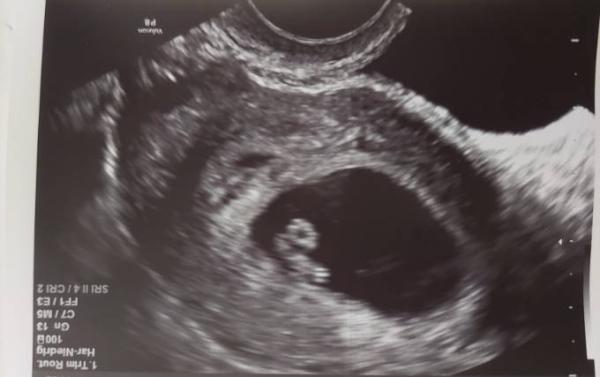 Bild zu Jemand Erfahrung mit der Ramzi Theorie? - Schwanger - wer noch? Rund um die Schwangerschaft