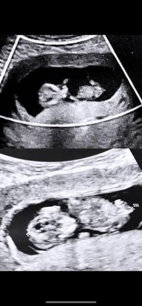 Bild zu Mädchen oder junge? 🥰 - Schwanger - wer noch? Rund um die Schwangerschaft