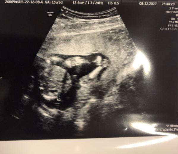Bild zu Baby Geschlechtsouting Ultraschall - Schwanger - wer noch? Rund um die Schwangerschaft