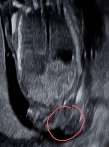 Bild zu Junge oder Mädchen - Wer sieht was? :D - Schwanger - wer noch? Rund um die Schwangerschaft