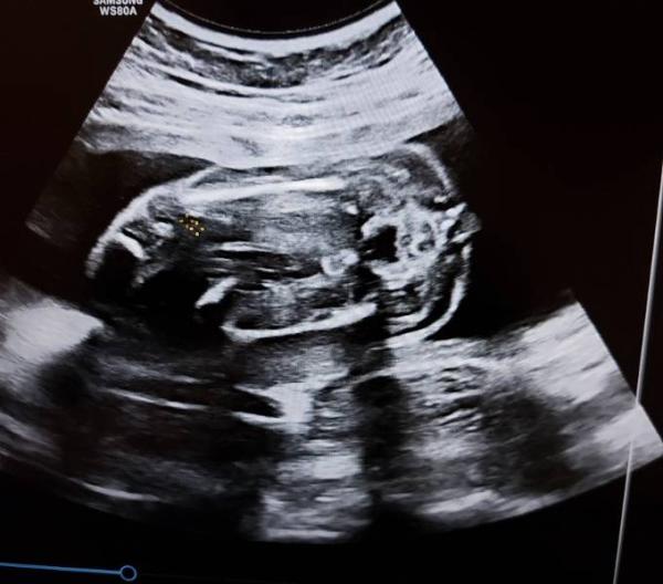 Bild zu Junge oder Mädchen? - Schwanger - wer noch? Rund um die Schwangerschaft