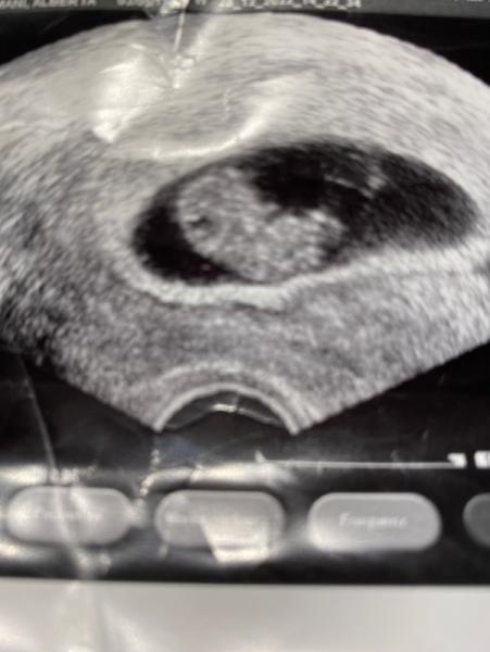 Bild zu 9+4 SSW - Geschlecht evtl. ersichtlich?! - Schwanger - wer noch? Rund um die Schwangerschaft