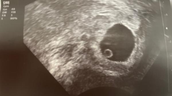 Bild zu Embryo? - Schwanger - wer noch? Rund um die Schwangerschaft