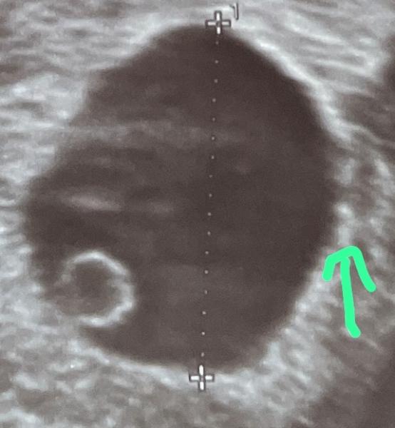 Bild zu Embryo 7 SSW - Schwanger - wer noch? Rund um die Schwangerschaft