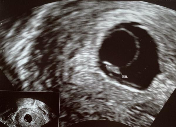 Bild zu Zweite Anlage ohne Embryo oder zu großer Dottersack? - Schwanger - wer noch? Rund um die Schwangerschaft