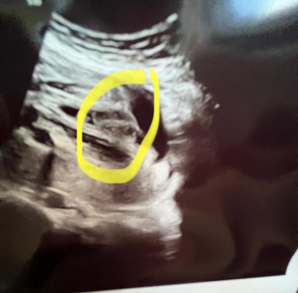 Bild zu Junge oder Mädchen - Schwanger - wer noch? Rund um die Schwangerschaft